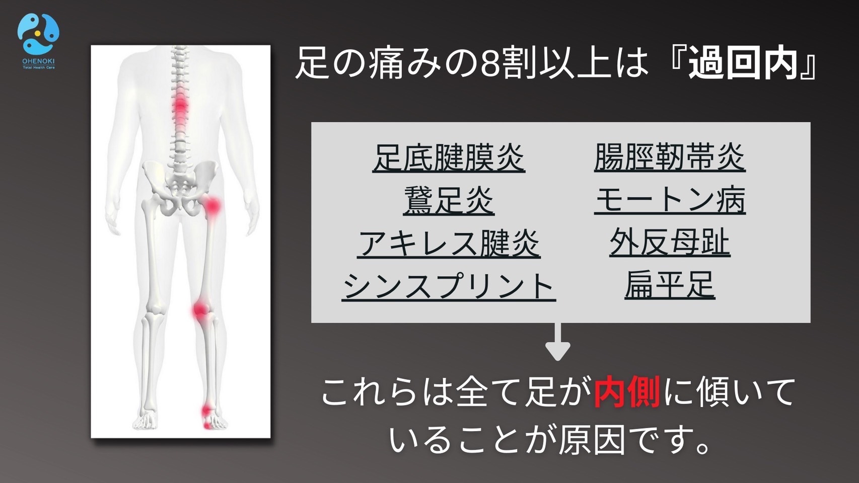 足の痛みの8割以上は「過回内」