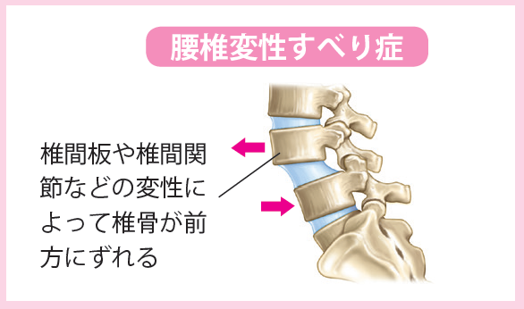 変性すべり