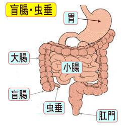 虫垂炎