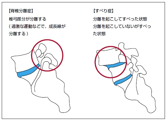 分離すべり